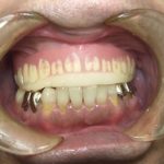 噛み合わせを直すための入れ歯
