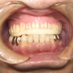 審美性、噛み合わせを回復させる治療入れ歯。