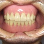 総入れ歯の難症例に対する当院の対応。