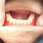 入れ歯の仮合わせは、大切な作業です。