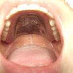 嘔吐反射のある人には、検討する価値がある金属床入れ歯。