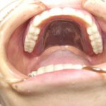チタンを使用した金属床の総入れ歯はメリットが多いです。