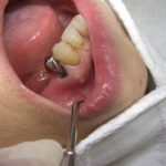 部分入れ歯のバネがかかっている歯は、特に注意しましょう。