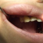 新しい入れ歯で食事をすると頬や舌を噛みやすいです。