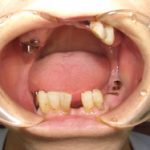 歯の欠損の放置が顎に問題を起こしているのかもしれませんよ。