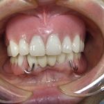 部分入れ歯で非常に難しい症例とは。。。