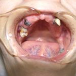 重度虫歯に乗っかる入れ歯は、かなりのリスクを抱えてます。