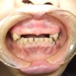 ノンクラスプ入れ歯は審美的に良いです。