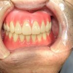 入れ歯の仮合わせの時には笑顔で確認します。