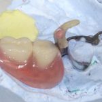 ノンクラスプ入れ歯に代わる審美的な入れ歯の紹介。