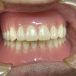 新しい入れ歯は舌や頬粘膜を噛みやすいものです。