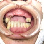 急な前歯の欠損は即時入れ歯で対応することがあります。