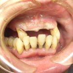 歯の欠損歯が１、２本でも放置はよくないです。