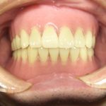 咬み合わせを修正するための、治療用入れ歯を作ることもあります。