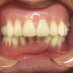 入れ歯に人工歯を足す作業をすることがあります。