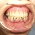 歯の欠損部の歯茎は少しずつ痩せていきますね。