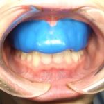 スポーツ歯学の勧め（３）
