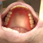初診の方は、年内中に入れ歯の完成は難しいです。
