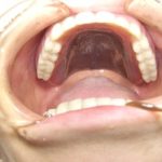 超難症例の入れ歯作りでも頑張ります。