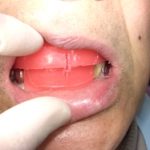 入れ歯の咬み合わせの高さを決めるために使う咬合床。
