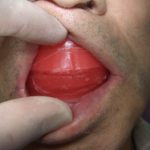 総入れ歯の咬み合わせのちょうど良い位置を決めるのは大変です。