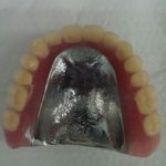 しょっちゅう入れ歯が壊れて困るのならば、是非、金属床入れ歯を考えてほしいです。