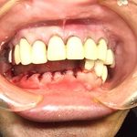 歯を抜いてすぐ装着する入れ歯は仮入れ歯だという認識です。