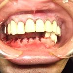 それ以上、歯が無くならないようにしましょう。
